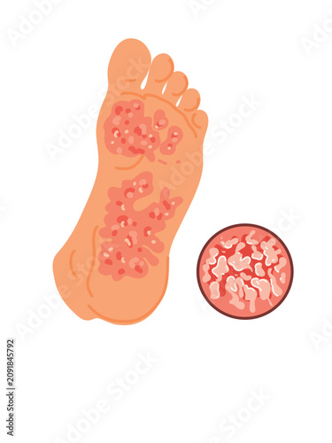 athlete foot fungal infection symptoms illustration