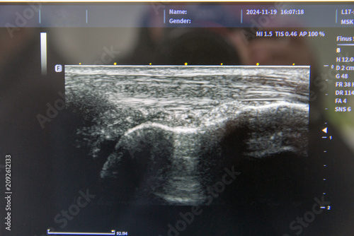 Medical ultrasound imaging of human musculoskeletal structure.