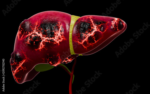 Liver Cancer Developing from Fatty Liver Disease Through Tumor Growth, Angiogenesis, Cellular Proliferation, and Progressive Tissue Damage in Human Anatomy 3D Rendering