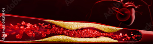Fatty plaque accumulation inside blood vessels showing arterial narrowing, restricted circulation, and increased risk of stroke, hypertension, and coronary artery disease. 3D Rendering