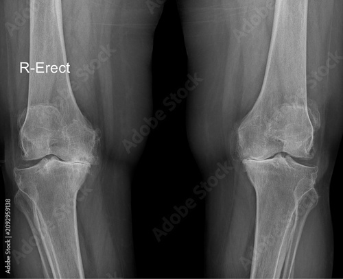 Weight-Bearing AP Bilateral Knee X-ray Demonstrating Advanced Medial Compartment Osteoarthritis