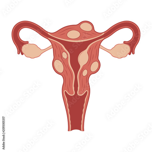 Anatomical Illustration of Human Uterus with Multiple Fibroid Growths