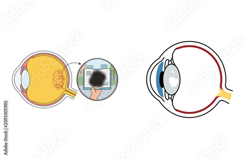 Foto Anatomical Diagram Illustrating Macular Degeneration and Human Eye Structure