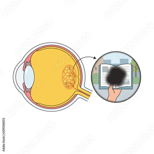 Canvastavla Anatomy of Human Eye Showing Macular Degeneration Causing Central Vision Loss