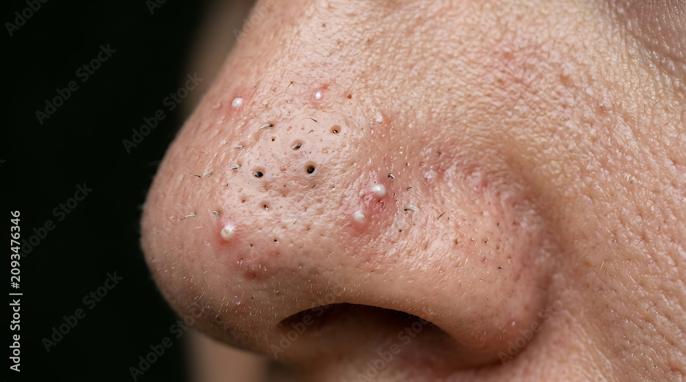 Naklejka premium Detailed Close Up of Human Nose Skin Texture Showing Acne Breakouts and Enlarged Pores