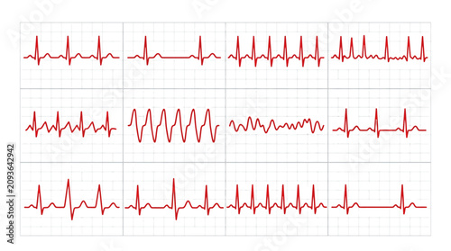 Bild auf Leinwand ECG heart rate monitor waves set, medical electrocardiogram rhythm chart collect
