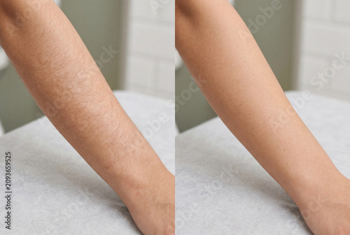 Woman's arm before and after laser hair removal process