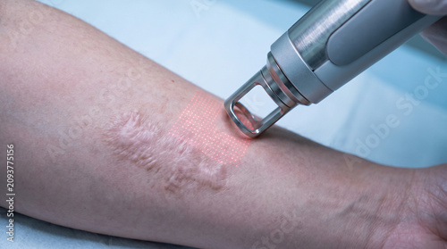 Professional fractional laser scar removal treatment on arm