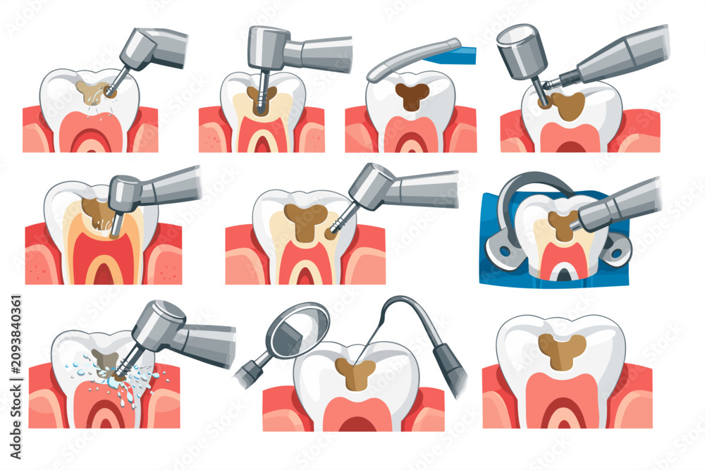 Naklejka premium Dental cavity preparation and filling process illustrated in multiple steps