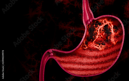 Microscopic Gastric Cancer Development Inside Human Stomach Anatomy and Digestive Tract 3D Rendering