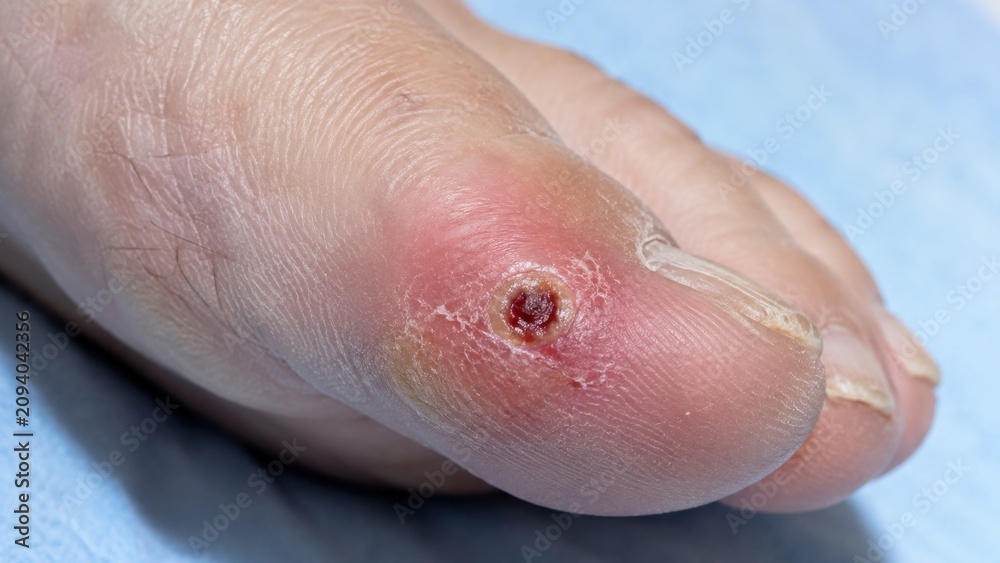 Fototapeta premium Ischemic ulcer on toe tip showing inflammation
