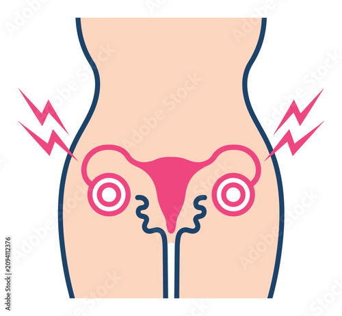 Bild auf Leinwand 骨盤痛 月経痛 生殖器系の健康問題を稲妻シンボル付きで示す女性の人体イラスト