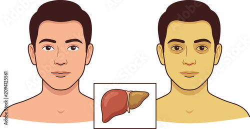Tableau sur toile Medical Infographic Comparing Normal Healthy Man Face and Yellow Skin Jaundice F