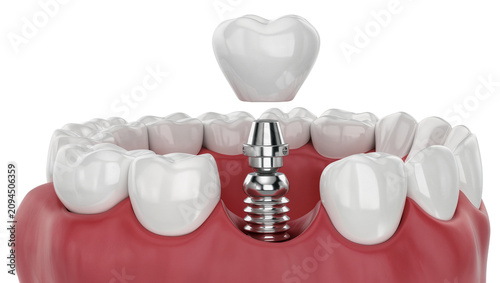 Canvastavla Isolated dental implant procedure showing crown placement on abutment and screw