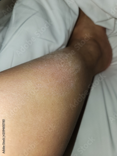 Dry skin as psoriasis disease