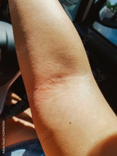 Detail of human skin reacting to an allergen with severe swelling, redness, and discomfort