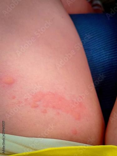 Medical detail of a severe skin allergy with itchy red patches and bumps on the body