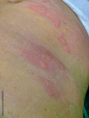Close-up of human skin on the abdomen showing a severe allergic reaction with red, raised hives and urticaria