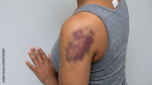 Round cupping bruises visible on a patient's back shoulder