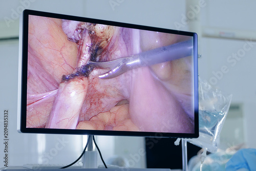 Foto Surgical monitor showing laparoscopic surgery to remove uterus and ovarian appen