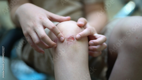 Foto Close-up of a child's knee sore and scraped wound