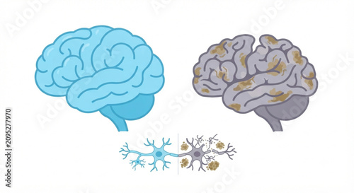 Alzheimer's Disease Brain Degeneration Illustration