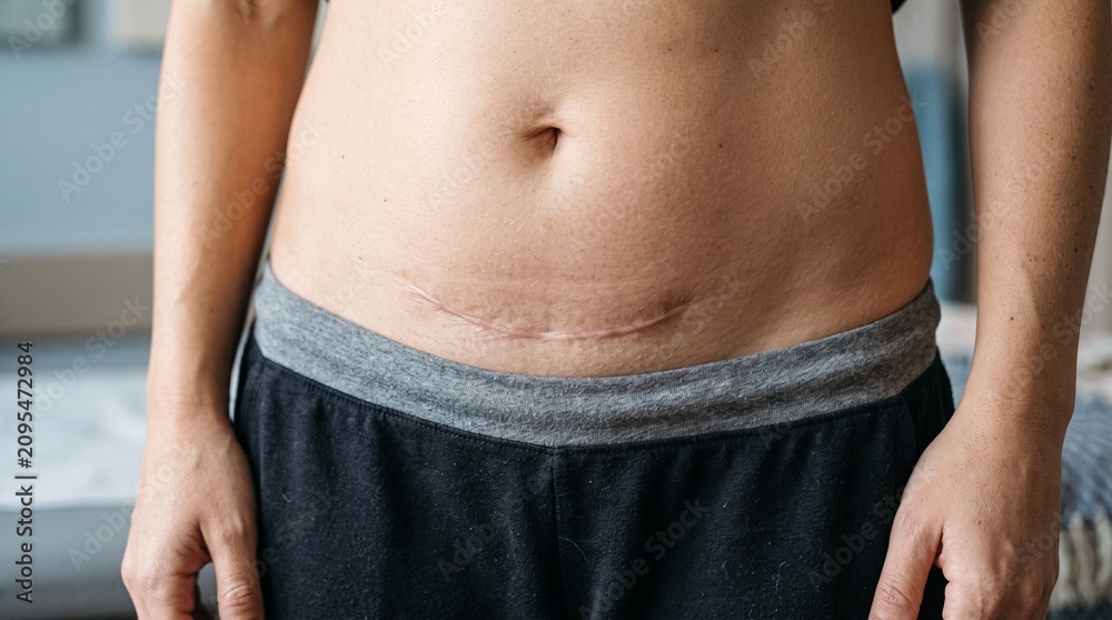 Naklejka premium Pfannenstiel (Cesarean Section) Scar 