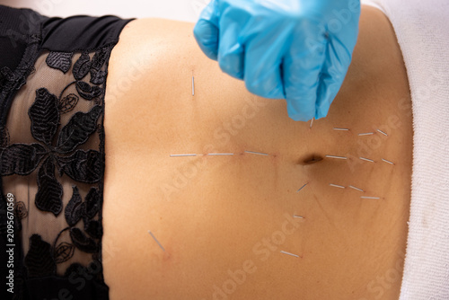 Close-up of a young woman receiving acupuncture treatment on her abdomen, professional practitioner in blue gloves placing fine needles for weight loss, digestive health, and holistic wellness.