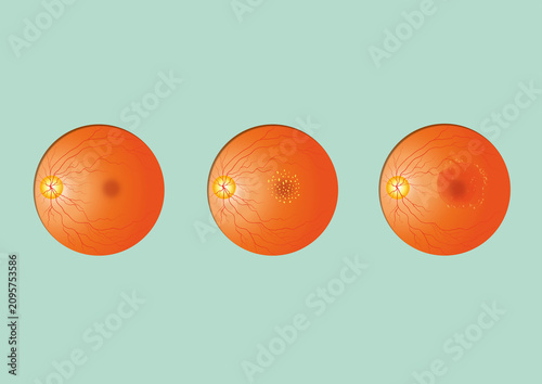 Macular degeneration, illustration