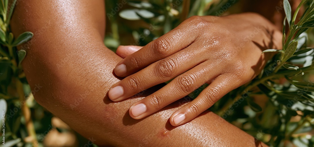 Obraz premium A hand tenderly calming insect bites on deep brown skin in natural sunlight, highlighting skincare comfort.