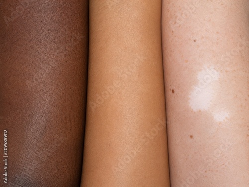 Close-up of three diverse arms showing different skin tones and vitiligo patch