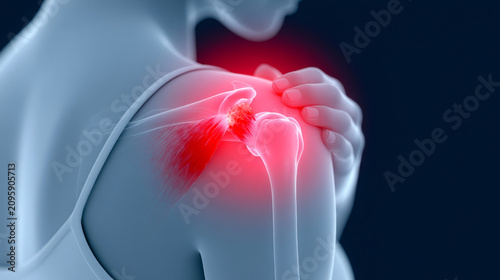 Rotator cuff injury illustration showing highlighted shoulder pain, muscle inflammation, and joint discomfort in female figure, useful for medical, physiotherapy, and anatomy concepts