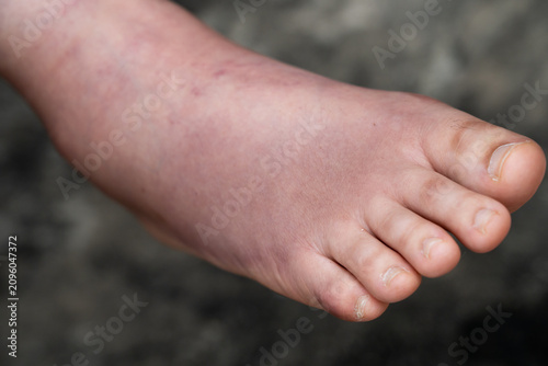 Photos Swollen Foot After Cast Removal of Metatarsal Fracture