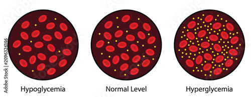 Bild auf Leinwand Medical Diagram Showing Hypoglycemia Normal Glucose and Hyperglycemia Blood Leve
