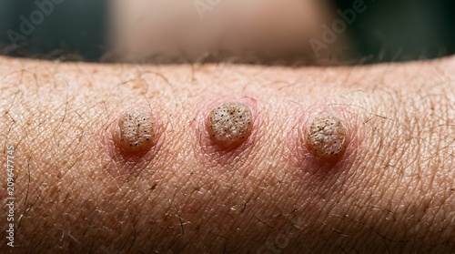 Extreme close-up macro of three inflamed skin warts on human arm