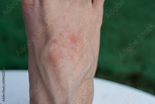 Schilderij op canvas Detailed macro shot of a dermatological issue showing red spotty rash on the skin surface of a foot