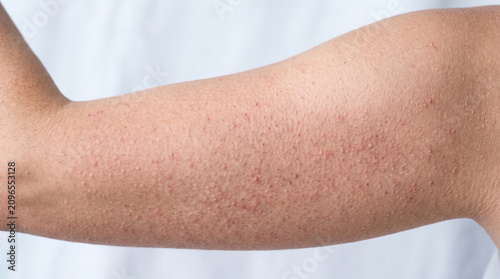 Upper arm with keratosis pilaris showing rough follicular papules chicken skin texture with redness, common benign skin condition dermatology concept