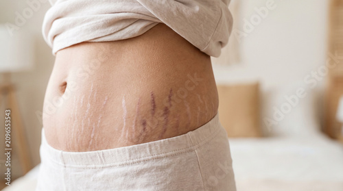 Abdomen with stretch marks striae distensae showing silver white and pink parallel skin lines on lower belly, skin condition body positive concept