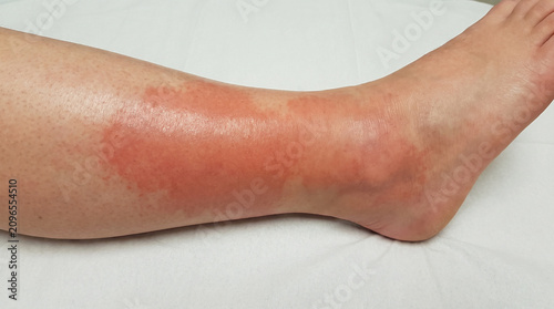 Lower leg with cellulitis showing diffuse red swollen inflamed skin bacterial infection spreading from ankle, dermatology medical skin infection concept