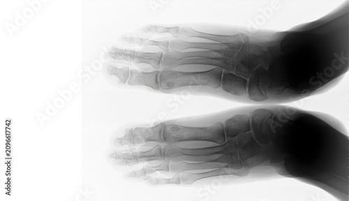 Tableau sur toile Medical X-ray of human feet, skeletal diagnostic imaging, isolated on white back