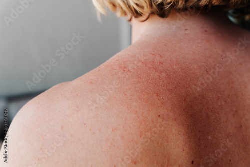 Tableau sur toile Close up of red irritated skin on a human back after prolonged sun exposure