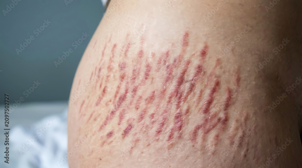 Fototapeta premium Close-up of skin with red-purple stretch marks
