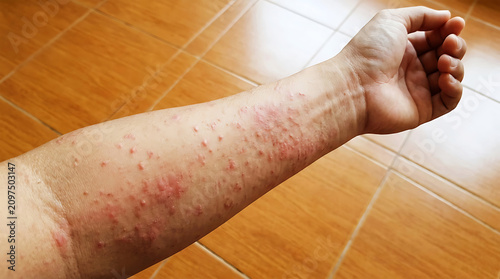 Red itchy rash on forearm, close-up view skin