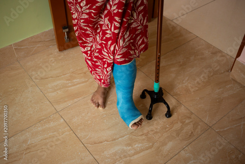 Broken leg
