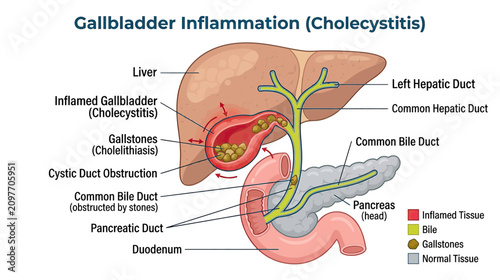 Gallbladder Inflammation (Cholecystitis) Anatomy Diagram with Gallstones and Liver