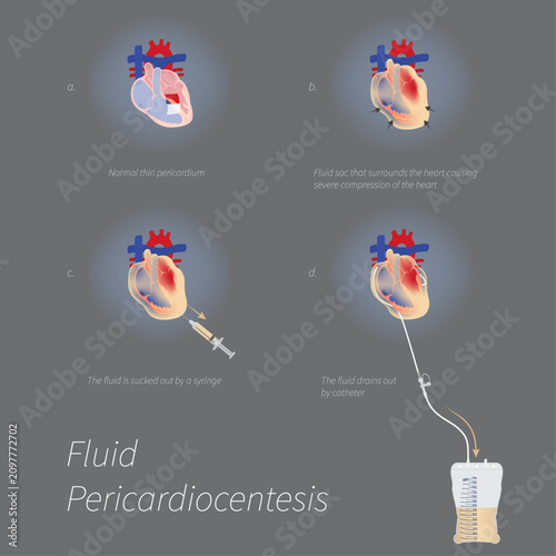 Photos Pericardiocentesis Fluid Drainage Medical Diagram