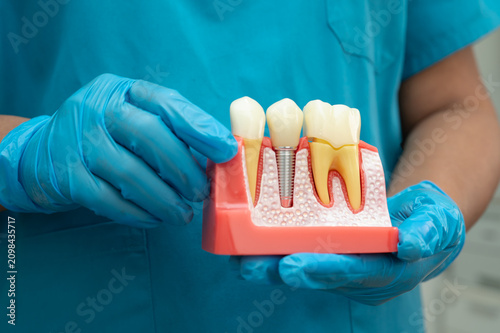 Asian dentist holding dental implant, artificial tooth roots into jaw, root canal of dental treatment, gum disease, teeth model for dentist.