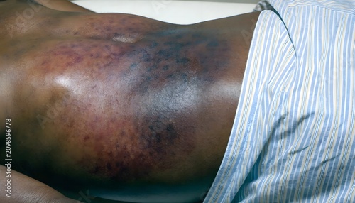Lateral view of abdominal flank contusion from internal hemorrhage. Clinical case of severe medical condition and skin discoloration for forensic study.