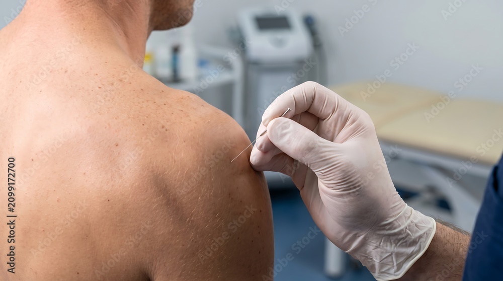 Fototapeta premium Physical therapist performing sterile dry needling therapy on athlete shoulder muscle