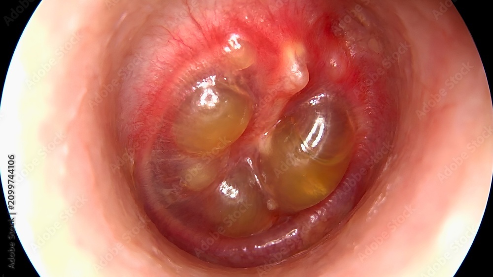 Fototapeta premium Otoscopic view of acute bullous myringitis showing tympanic membrane bullae